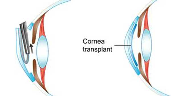 diagram of the removal of patient's endothelium and insertion of new very thin endothelial grft through small incision in periphery of their cornea during surgery